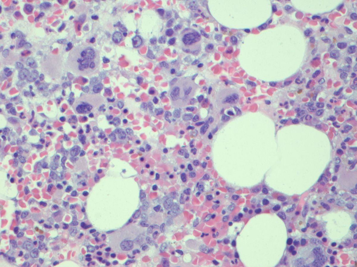 Persistent myelodysplasia after treatment
